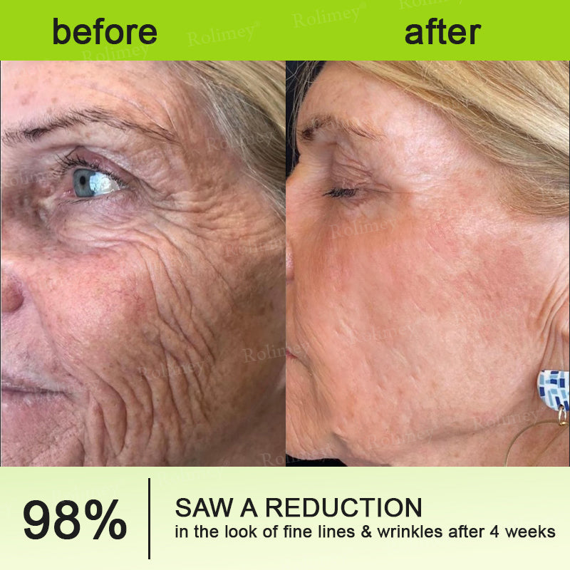 🍈Rolimey® Botox & Vita-A Retinol Shot Wrinkle-Lift Tightening cream - Last Day Promotion 70% OFF