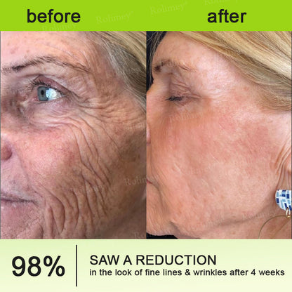 🍈Rolimey® Botox & Vita-A Retinol Shot Wrinkle-Lift Tightening cream - Last Day Promotion 70% OFF