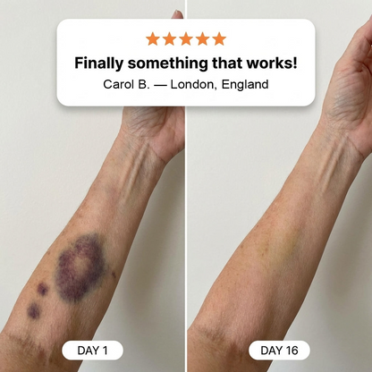 💥Over 100,000 units sold💕 - Rolimey® cream to repair bruises and strengthen the skin