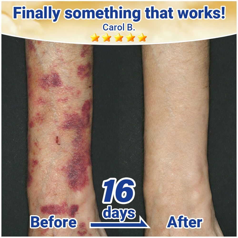 💥 2026 Best-Selling Skin Care | Rolimey® Bruise Care Cream | Advanced Care for Fragile, Aging & Bruise-Prone Skin