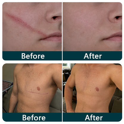💖🎁TRILUMIA® SILICONE SCAR THERAPY ROLL  Help Soften, Flatten & Improve the Appearance of Raised Scars