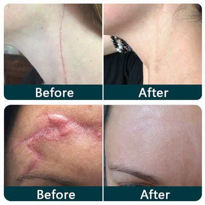 💖🎁TRILUMIA® SILICONE SCAR THERAPY ROLL  Help Soften, Flatten & Improve the Appearance of Raised Scars