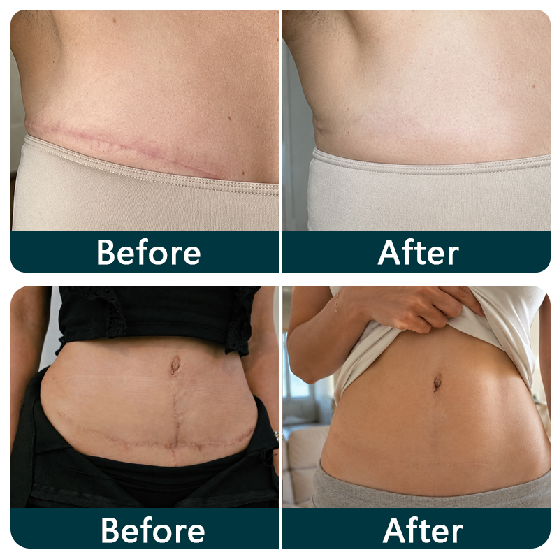💖🎁TRILUMIA® SILICONE SCAR THERAPY ROLL  Help Soften, Flatten & Improve the Appearance of Raised Scars